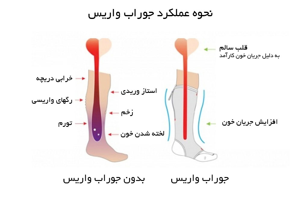 نحوه عملکرد جوراب واریس